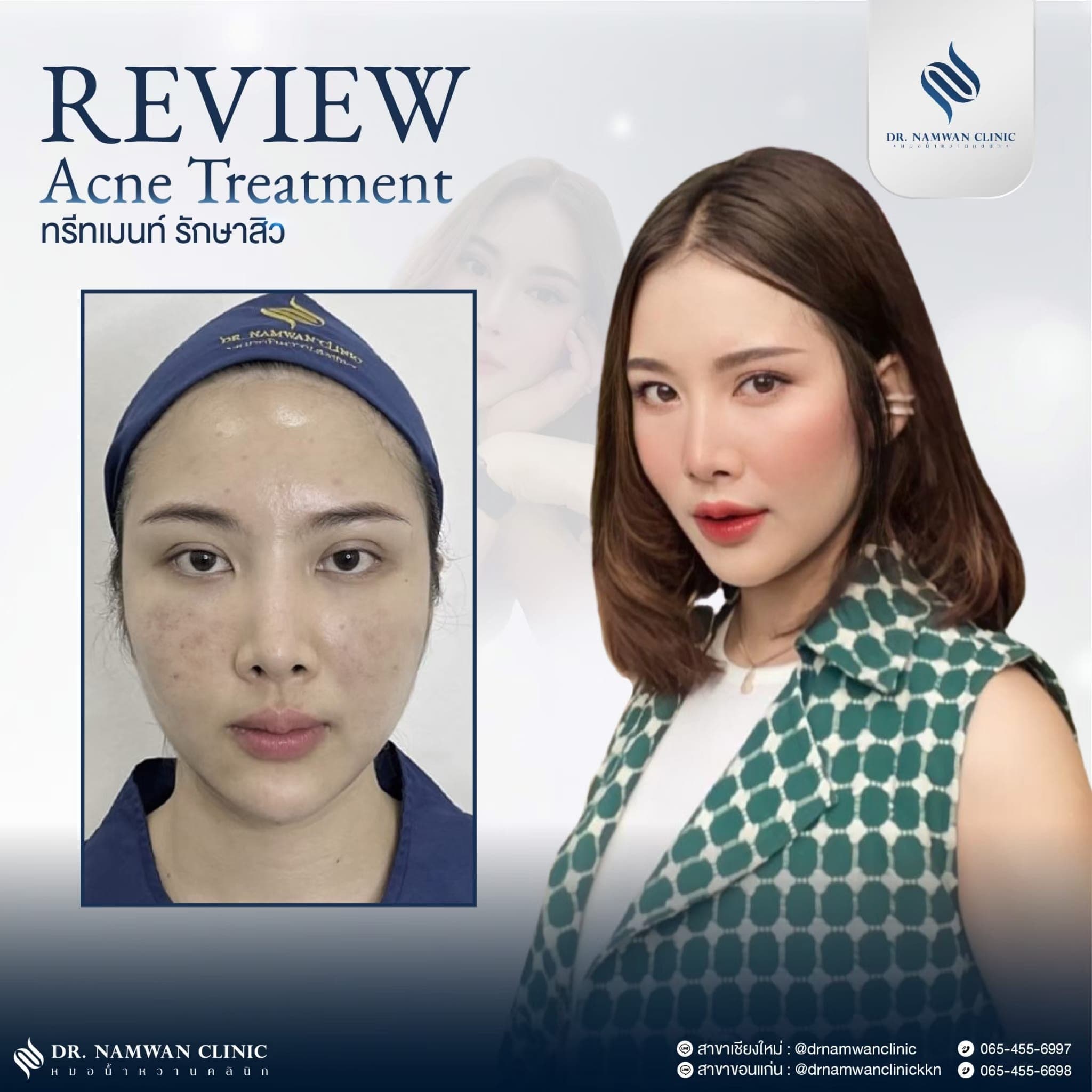 ผลลัพธ์ก่อน–หลัง โปรแกรมรักษาสิว / หน้าใส