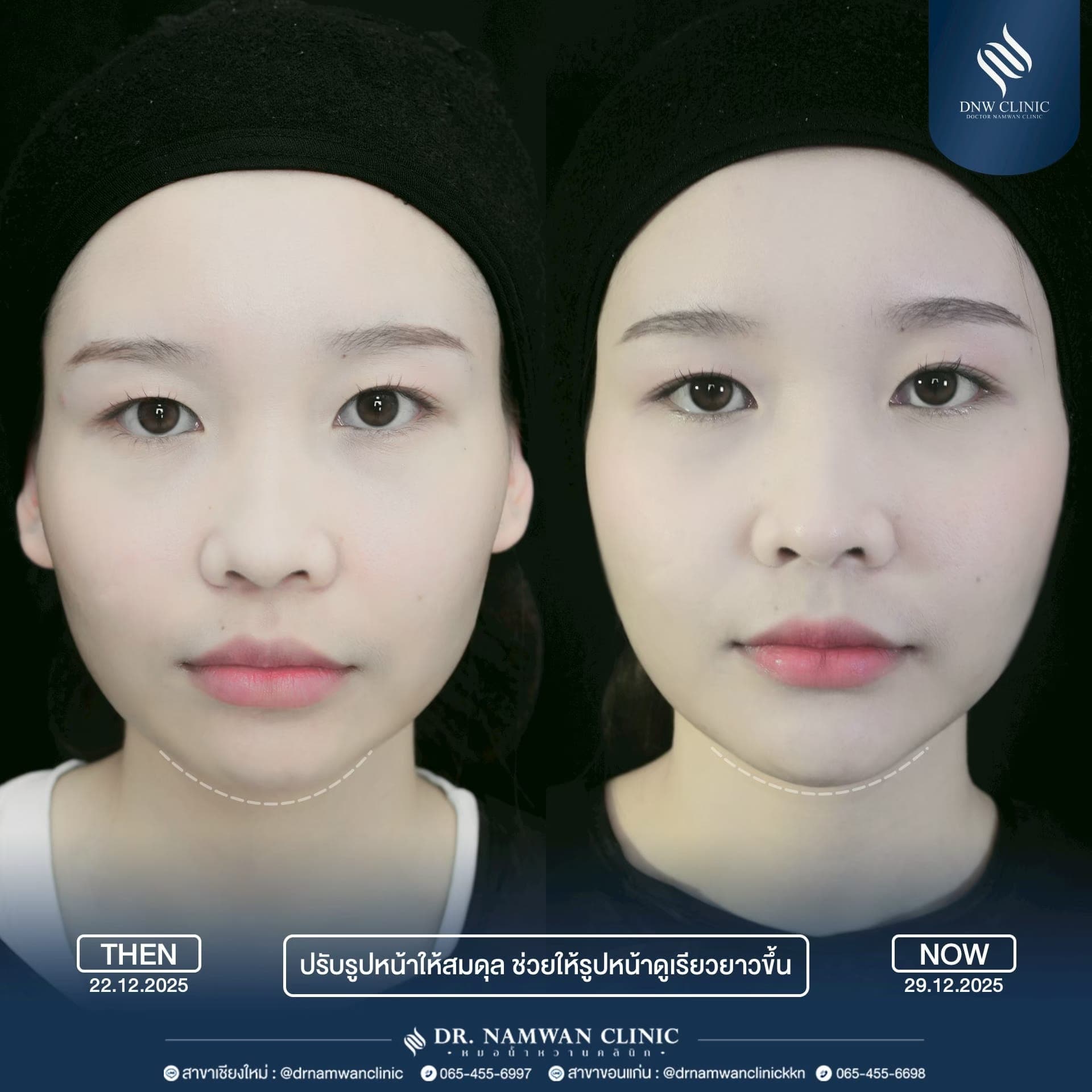 ผลลัพธ์ก่อน–หลัง โปรแกรมฉีดฟิลเลอร์